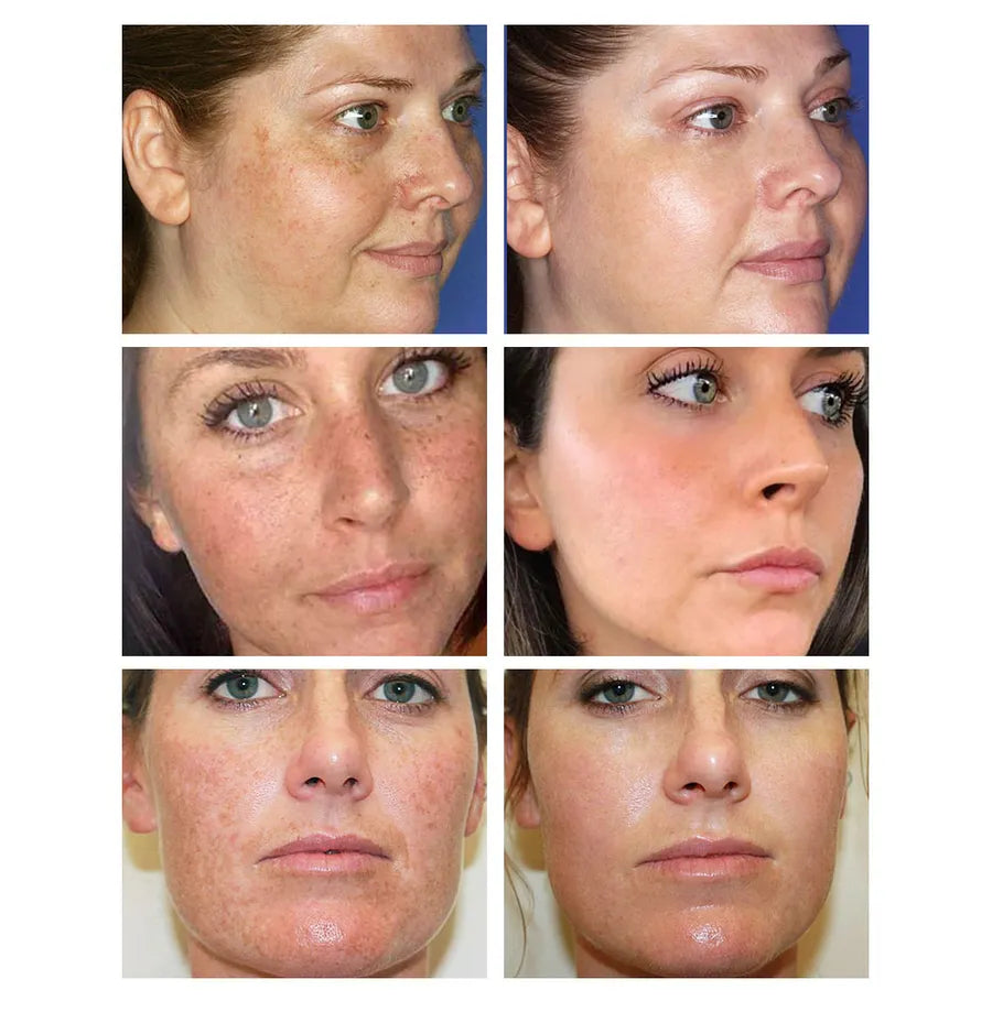 SKINPURE PRO - Nicotinamide Anti-Manchas & Control de Grasa.